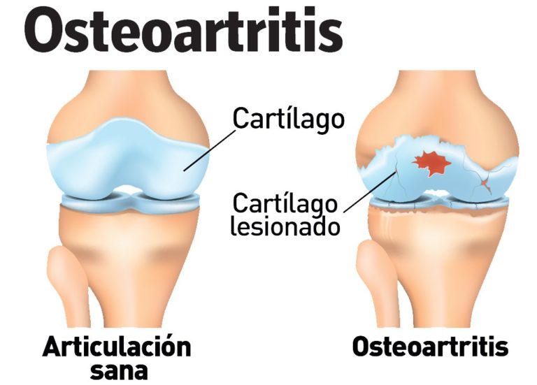 Condroitin Sulfato ¿Qué es?, ¿Para qué sirve?, nombre comercial y más