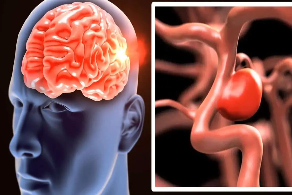 Accidentes Cerebrovasculares Y Como Identificarlos