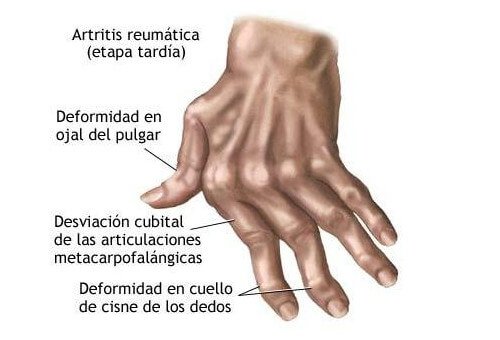 artritis reumatica