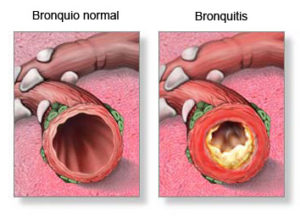 Clorotrimeton-Bronquiolitis