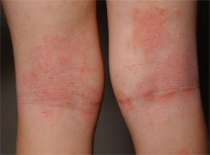 Clorotrimeton-Dermatitis 