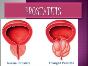 cefalexina para prostatitis