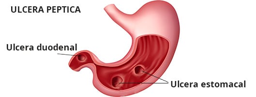 Ulceras péptica