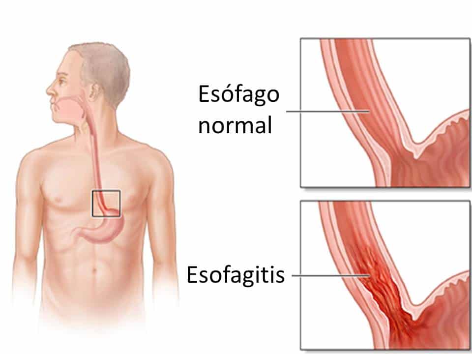 ranitidina esofagitis