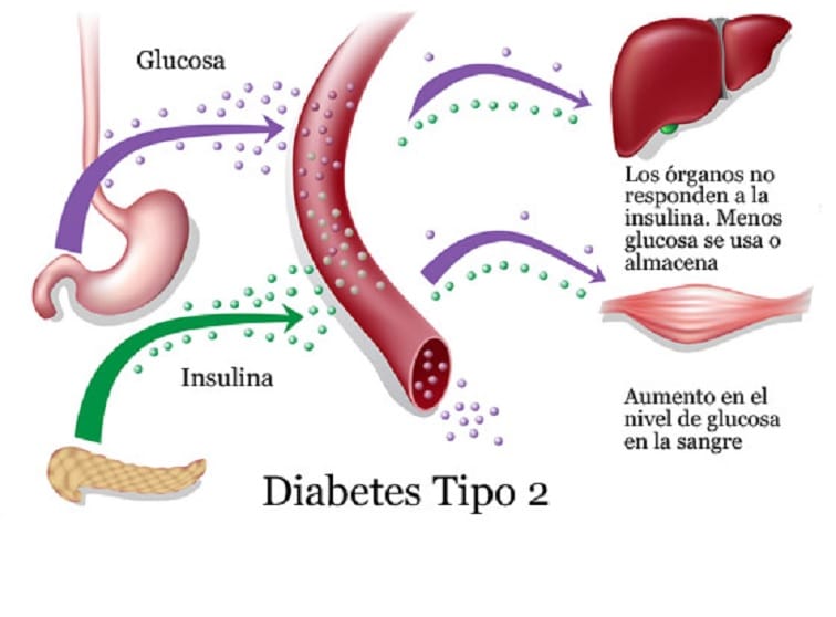 diabetes tipo 2 