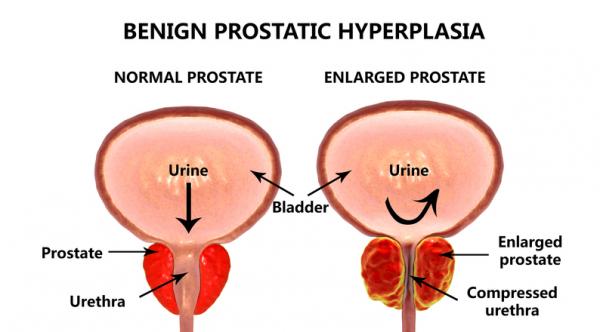Vesicar és prostatitis Prostatitis és álmosság
