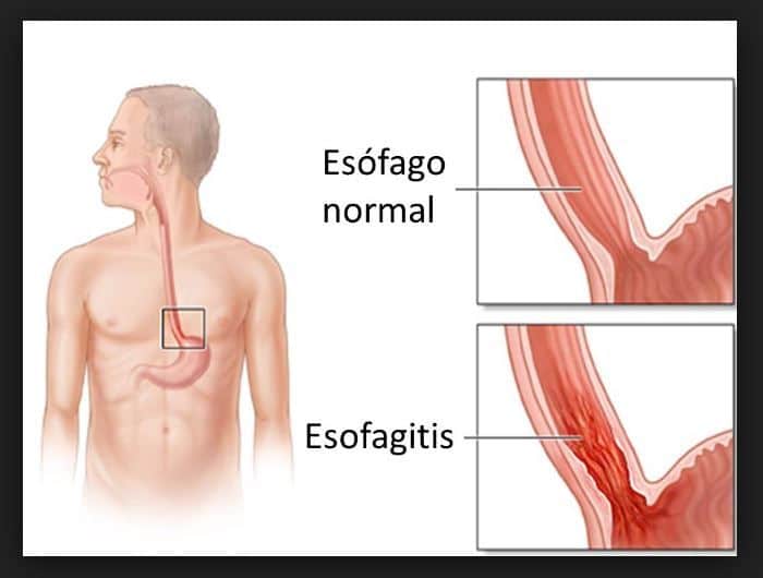 esomeprazol esofagitis