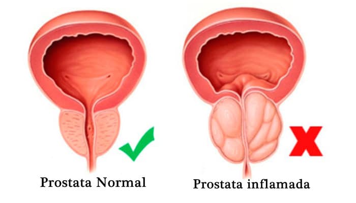 tamsulosina prostata