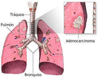 gefitinib pulmones
