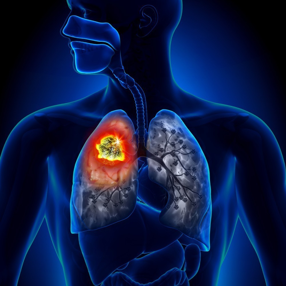 tegafur cancer pulmon