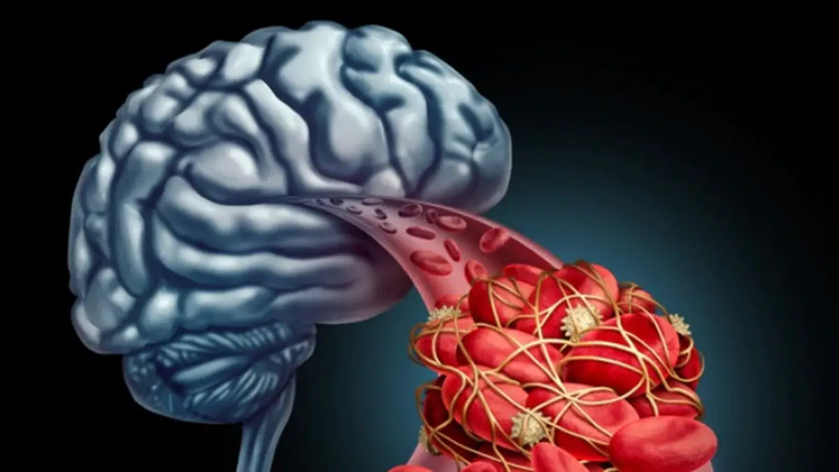 Accidentes Cerebrovasculares Y Como Identificarlos